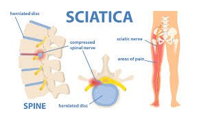 Sciatica specialist in Noida